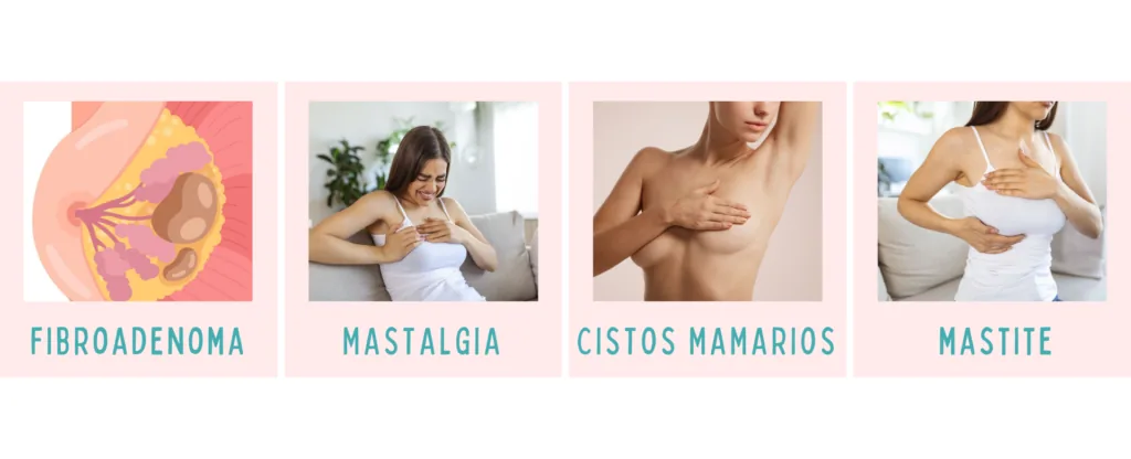 imagem com quatro doenças benignas da mama