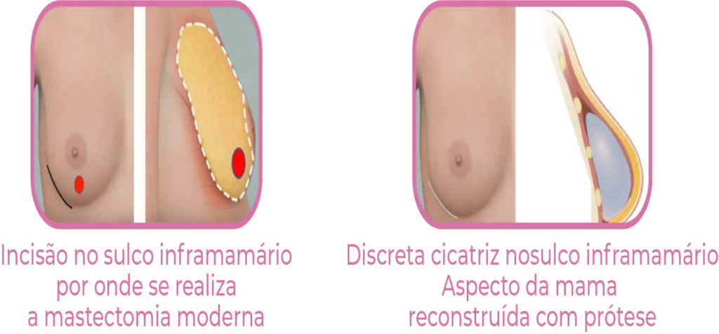 Técnicas de reconstrução mamária após mastectomia