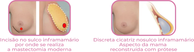 Infográfico apresenta técnias de reconstrução mamária após mastectomia