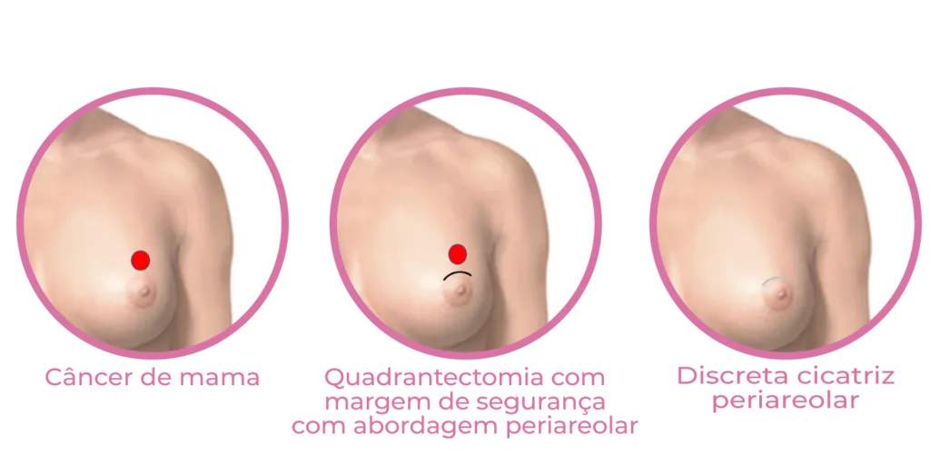 Infográfico apresente etapas da cirurgia conservadora de mama - quadrantectomia