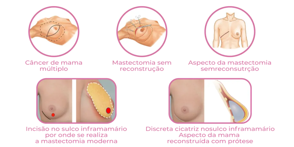 Infográfico apresente tipos de cirurgia da mama